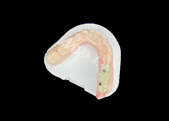 PFM Dental Crowns Lifelike and Corrosion Resistant for Optimal Oral Health