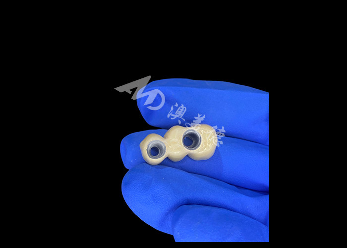 PFM Dental Crowns Lifelike and Corrosion Resistant for Optimal Oral Health