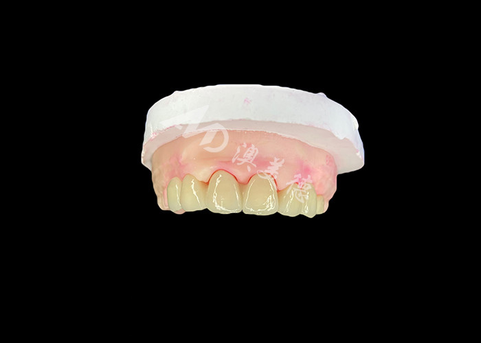 Wieland Zenostar Ceramic Crown Bridge High Precision for Durable and Natural Looking Restorations
