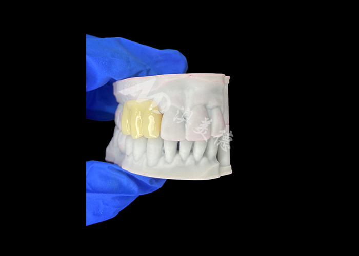 Lightweight Biocompatible 3D Printed Hollow Temporary Bridge for Pre Implant Restorations