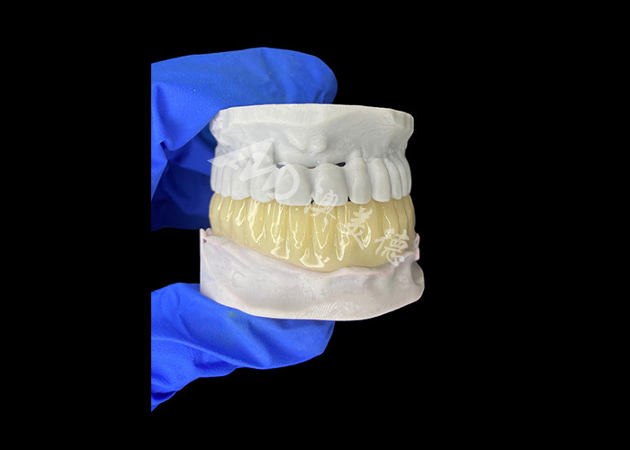 Lightweight Biocompatible 3D Printed Hollow Temporary Bridge for Pre Implant Restorations