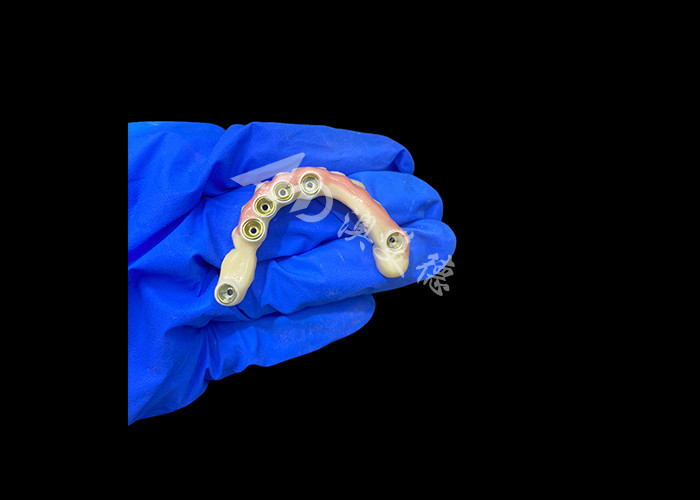 Titanium Abutment and Zirconia Crown Implant Supported Dentures Precision Fit for Comfortable Wear