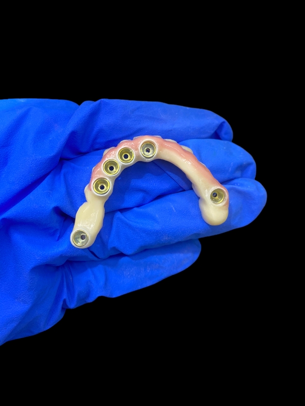 Titanium Abutment and Zirconia Crown Implant Supported Dentures Precision Fit for Comfortable Wear