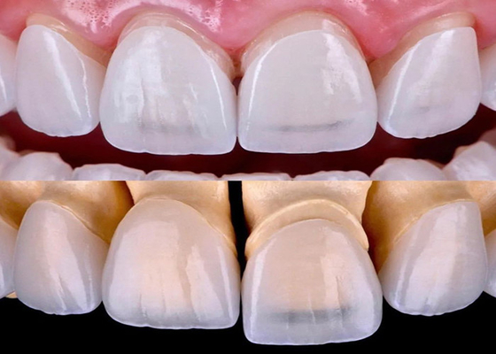 Good price Long Lasting Dental EMAX Veneer Fabricated With All Ceramic Zirconium Material online
