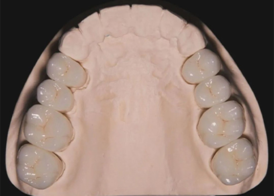Good price Dental Restoration Teeth Zirconia dental Crowns crafted by china dental lab online
