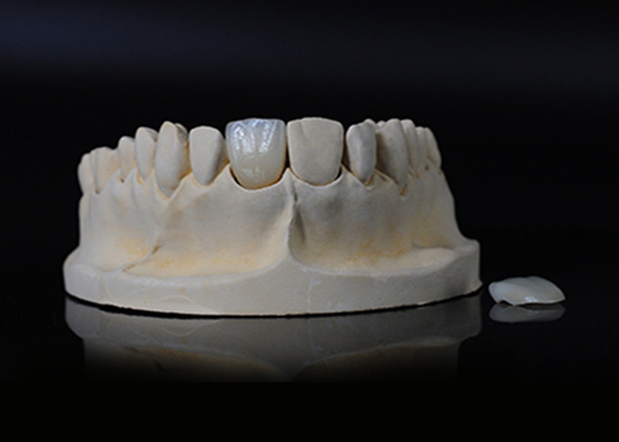 Good price Translucency Porcelain Emax Veneer for Excellent Fit / Natural Esthetics online