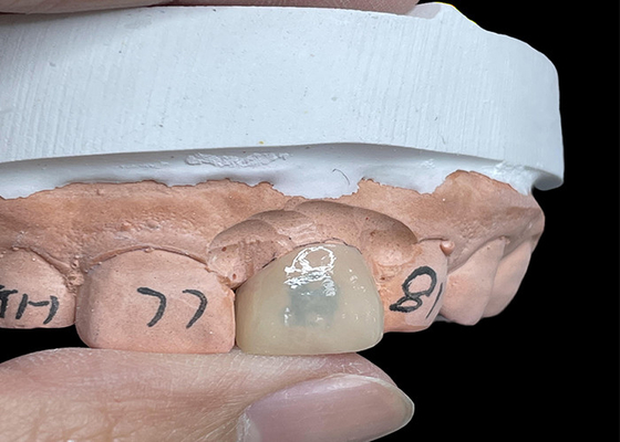 Good price EMAX Veneers Transform Your Smile with Highly Translucent Natural Looking Teeth online
