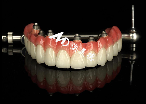 Good price Customized Dental Implant supported dentures Crown Bridge For Missing Teeth Maintenance online
