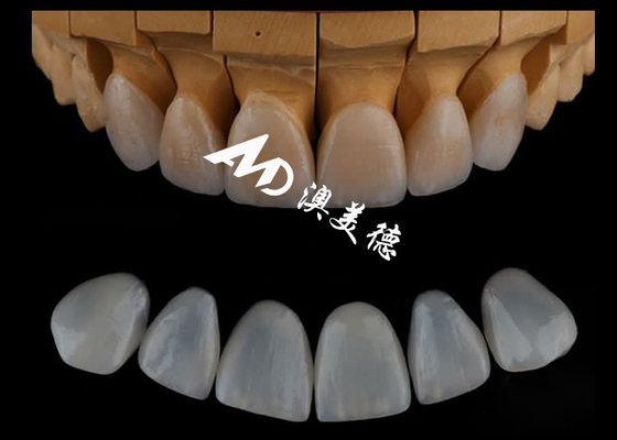 Good price Highly Accurate Customized Emax  Veneers/porcelain Dental Veneer For Cosmetric Dentistry online