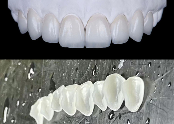 Good price IPS emax Press Porcelain Veneers Achieve a Natural and Radiant Smile online