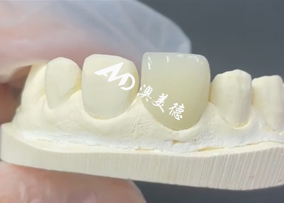 Good price Durable and Aesthetic EMAX Veneer The Perfect Solution for Porcelain Restorations online