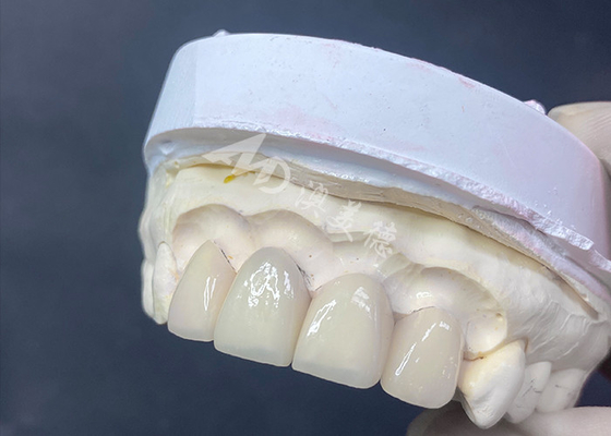 Good price Precision-Crafted Dental Veneers Excellent Fit and High Translucency for Flawless Smile online