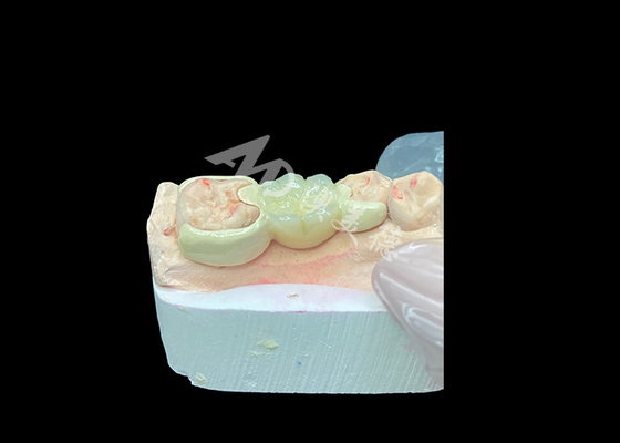 Good price Zirconia Crown with HPP Bonded Bridge for Enhanced Smile Aesthetics and Biocompatibility online