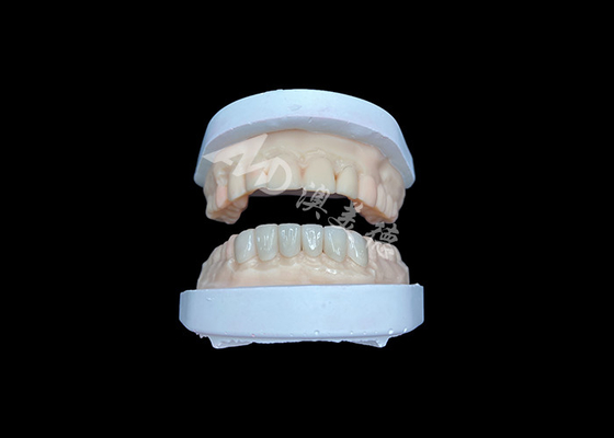 Good price IPS Emax Veneers Natural Looking Restorations For Esthetic Smiles online