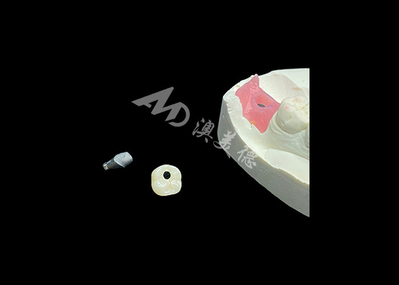 Good price Long-lasting Dental Implant Crowns Revolutionizing Restorative Dentistry Procedure online