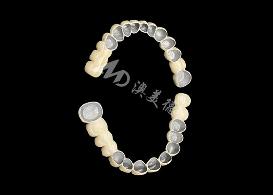 Good price Customized Porcelain Fused To Metal Dental Crown Bridge For Natural Smile Enhancement online