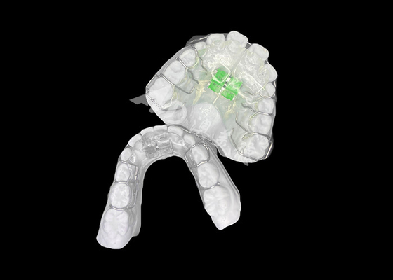 Good price Effective Removable Orthodontic Expander For Optimal Jaw Alignment And Dental Health online