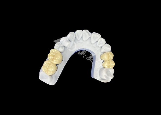 Good price Zirconia PFZ Porcelain Dental Crown From Professional China Dental Lab online