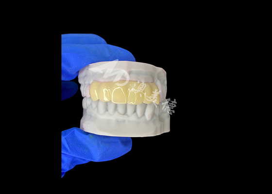 Good price Lightweight Biocompatible 3D Printed Hollow Temporary Bridge for Pre Implant Restorations online