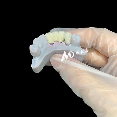 Good price Zirconia Dental Crown with Metal Post Core Offering Natural-Looking Aesthetics Precise Adaptation and Superior Biocompatibility online