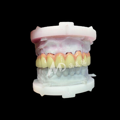 Good price Pure Titanium Ceramic Crown and Bridge Durable Lightweight Aesthetic Restorations online