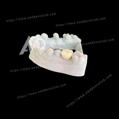 Good price PFM Maryland Bridge One Pontic Two Wings A Conservative and Esthetic Solution online